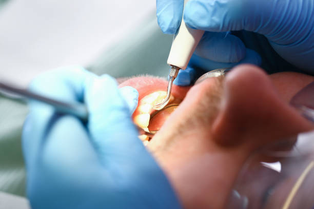 Best Emergency Dentist for Knocked-Out Tooth in Unionville, MO