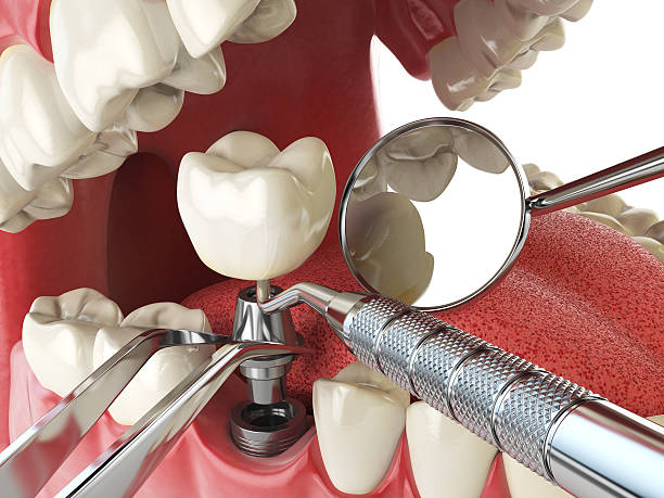 Best Emergency Dental Extractions in Unionville, MO
